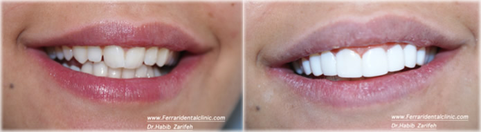 composite-veneers-hollywood-smile