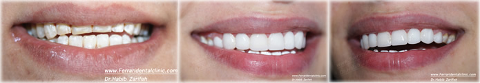 composite-veneers-hollywood-smile