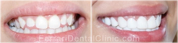 composite-veneers