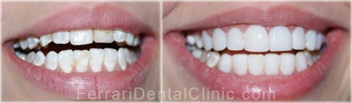 composite-veneers