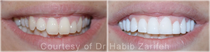 composite-veneers