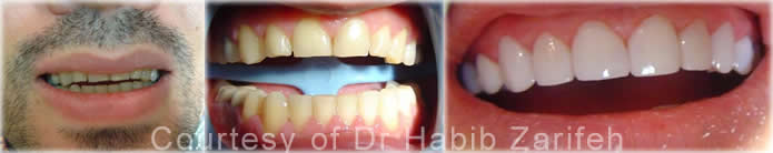 composite-veneers