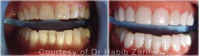 composite-veneers