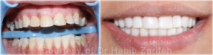 composite-veneers