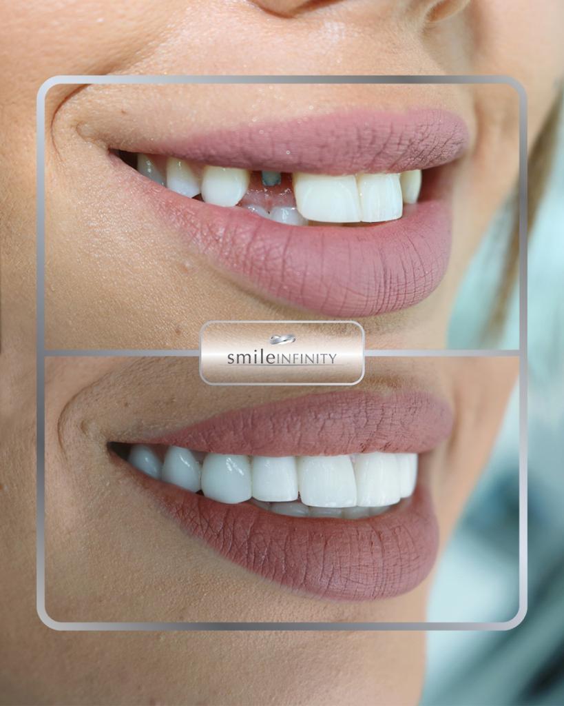 Dental implant crown before after female patient Smile Infinity Ferrari Dental Clinic Beirut Lebanon