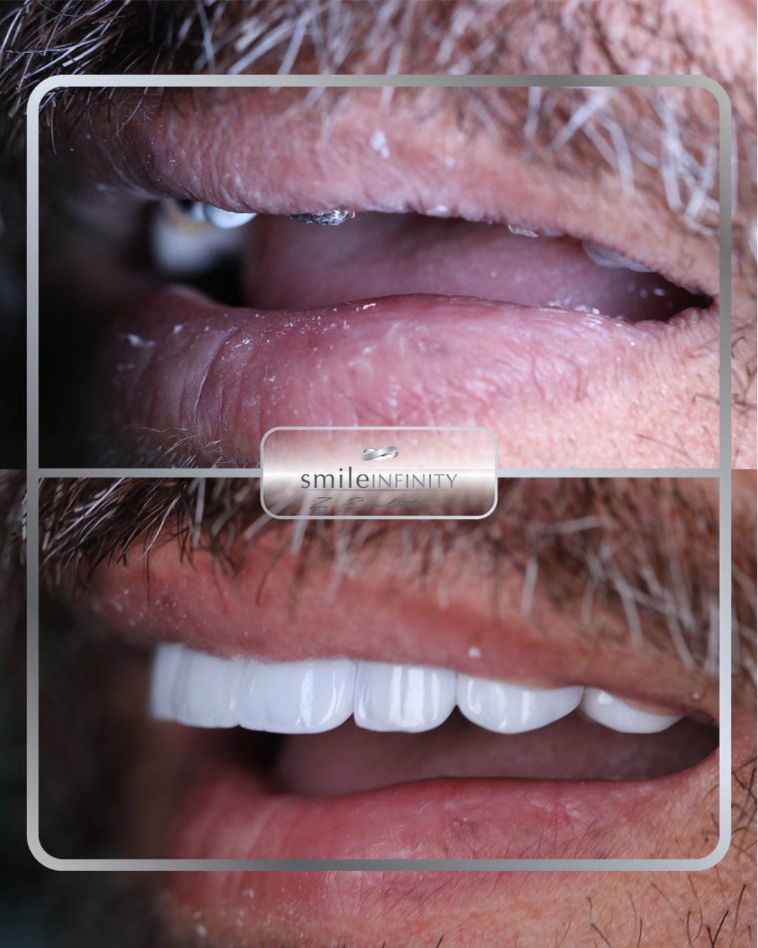 Full arch implant rehabilitation before after male patient Dr Habib Zarifeh Ferrari Dental Clinic Beirut Lebanon