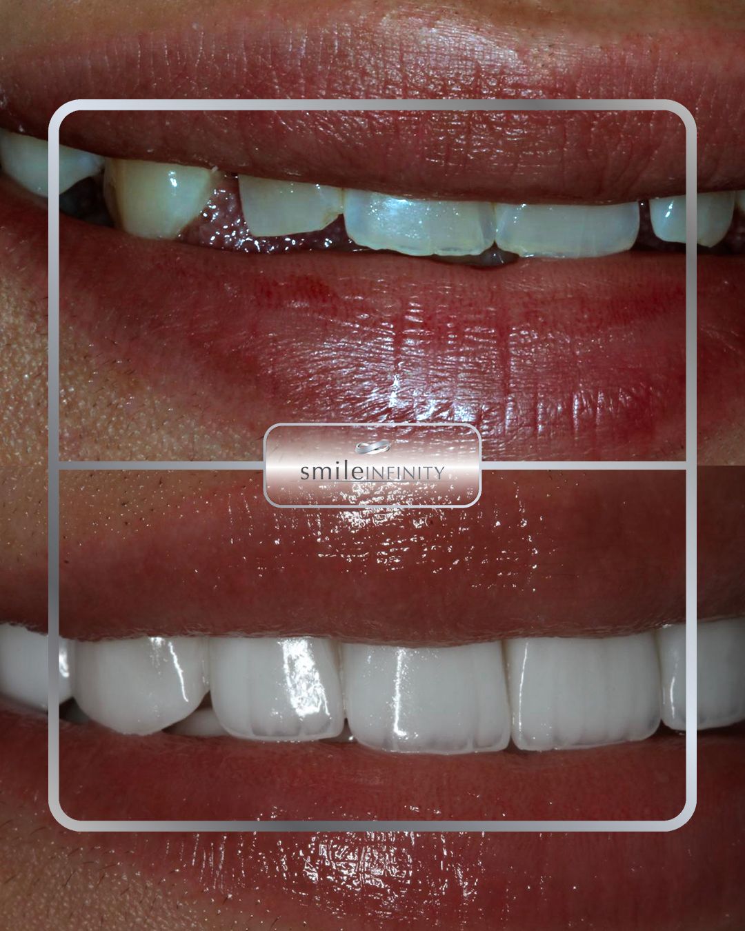 Hollywood Smile Lumineers veneers before after female patient Ferrari Dental Clinic Beirut Lebanon Dr Habib Zarifeh