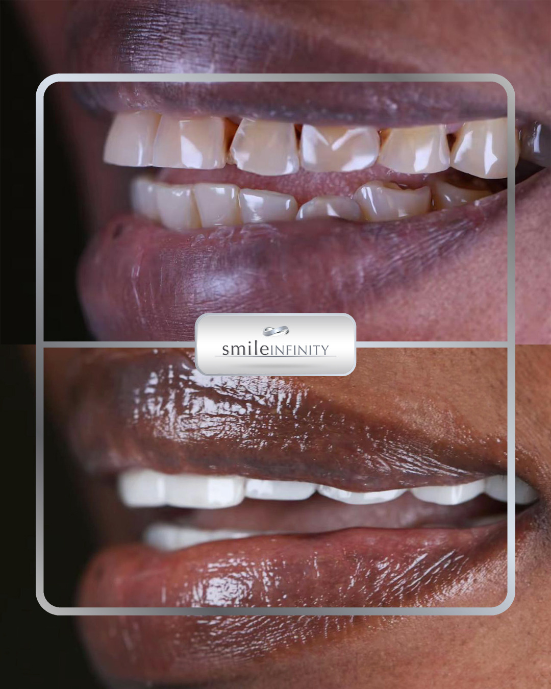 Hollywood Smile international patient Africa veneers before after Smile Infinity Ferrari Dental Clinic Beirut Lebanon