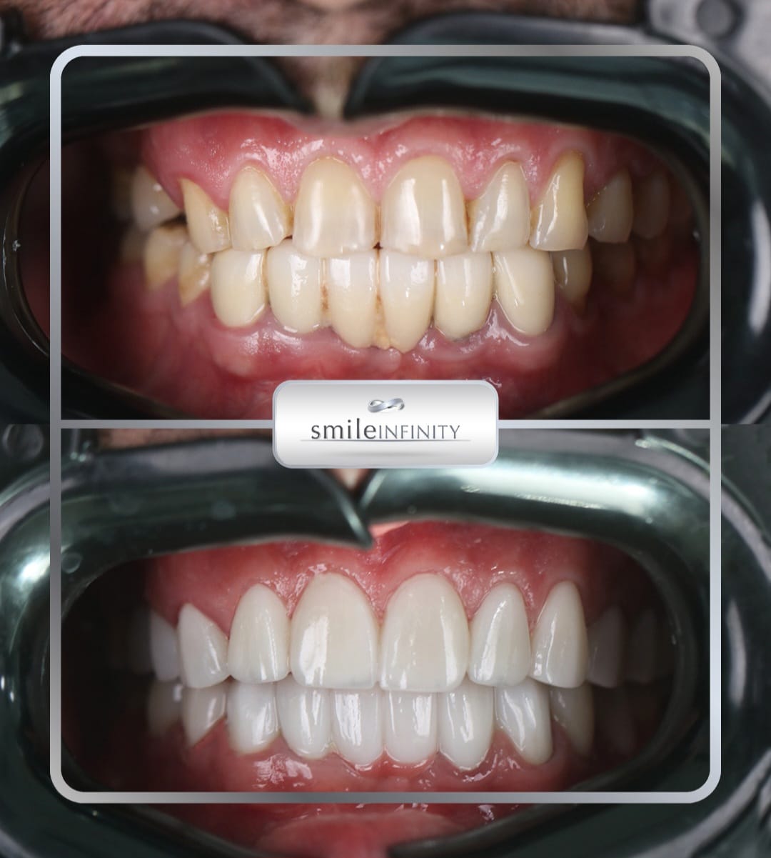 Full arch ceramic veneers before after retractor Smile Infinity Ferrari Dental Clinic Beirut Lebanon