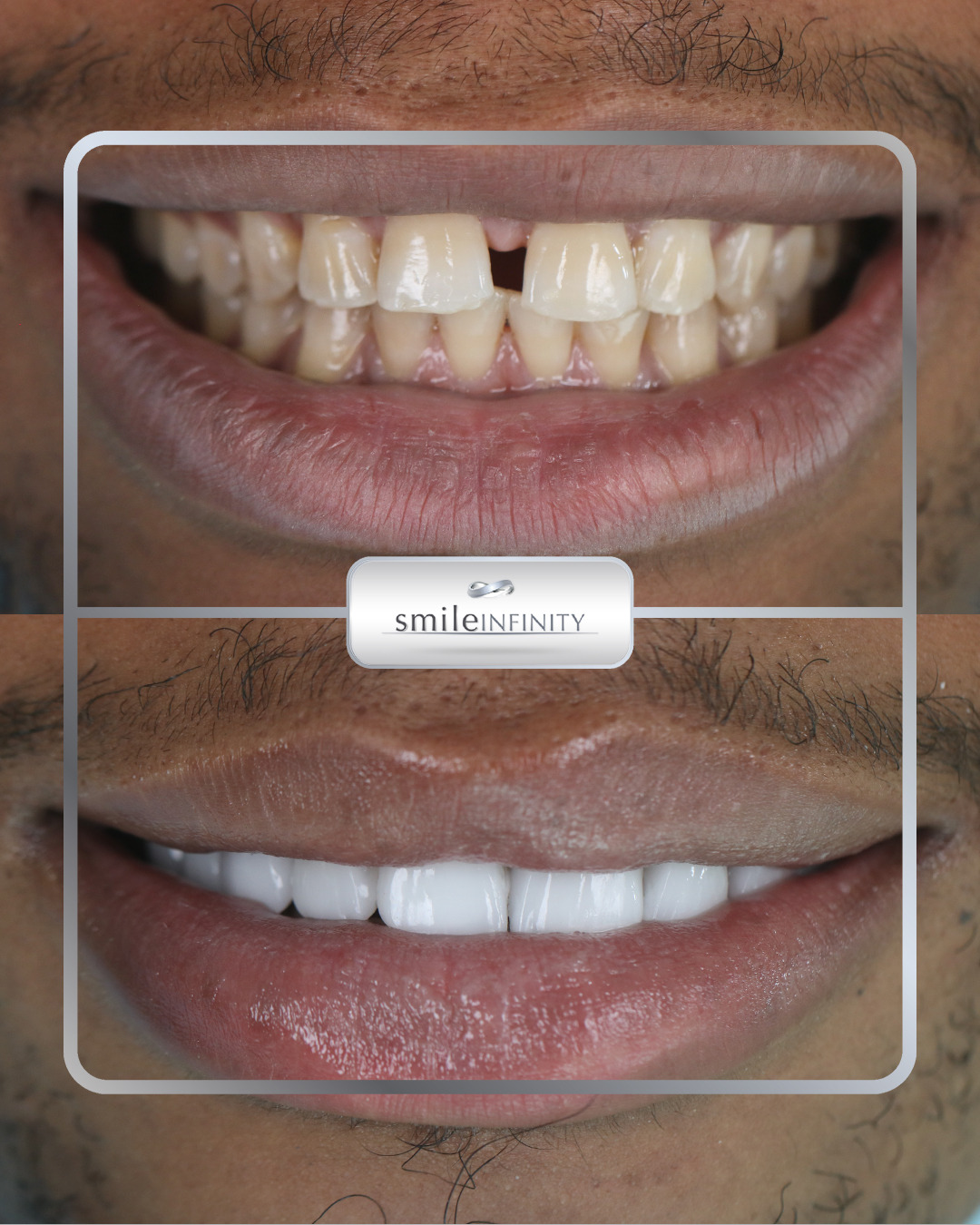 Lumineers gap closure before after male patient Smile Infinity Ferrari Dental Clinic Beirut Lebanon