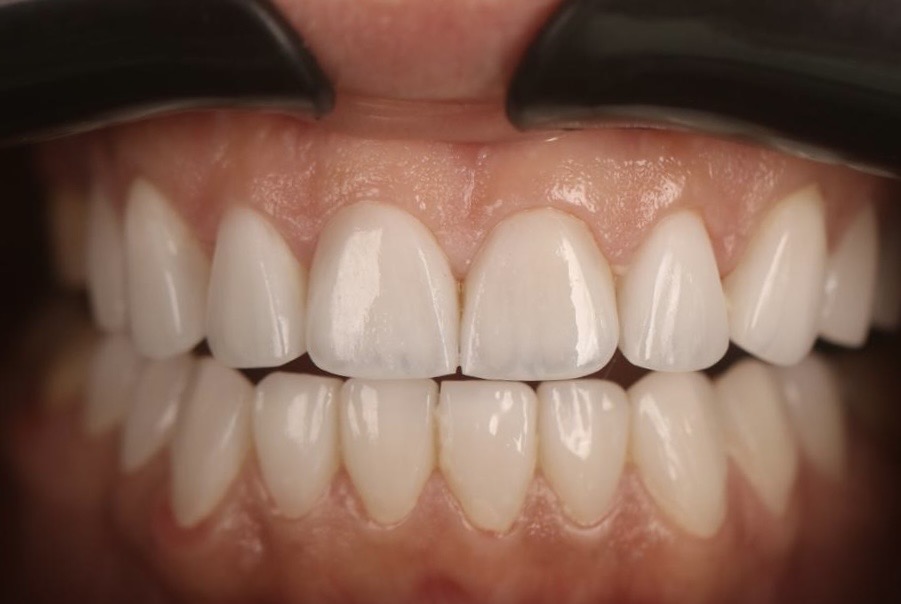 Lumineers Hollywood Smile result full arch beautiful white teeth Ferrari Dental Clinic Beirut Lebanon