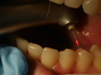 operative-laser-dentistry1