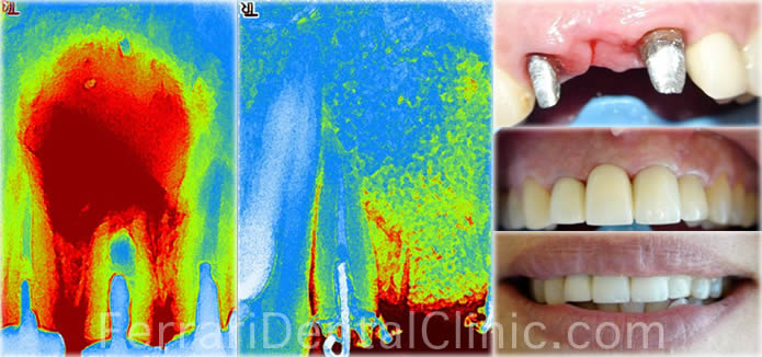 oral-surgery-bone-graft