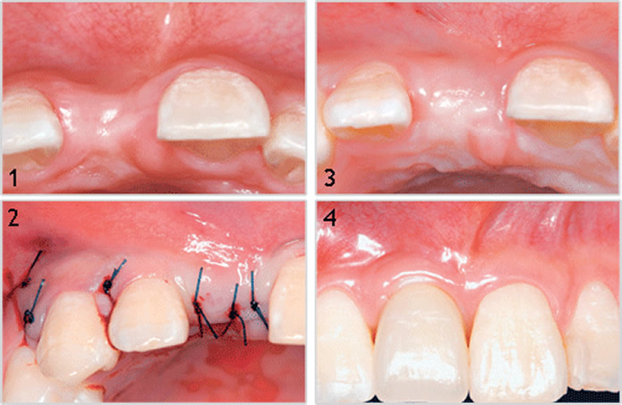 oral-surgery-bone-graft