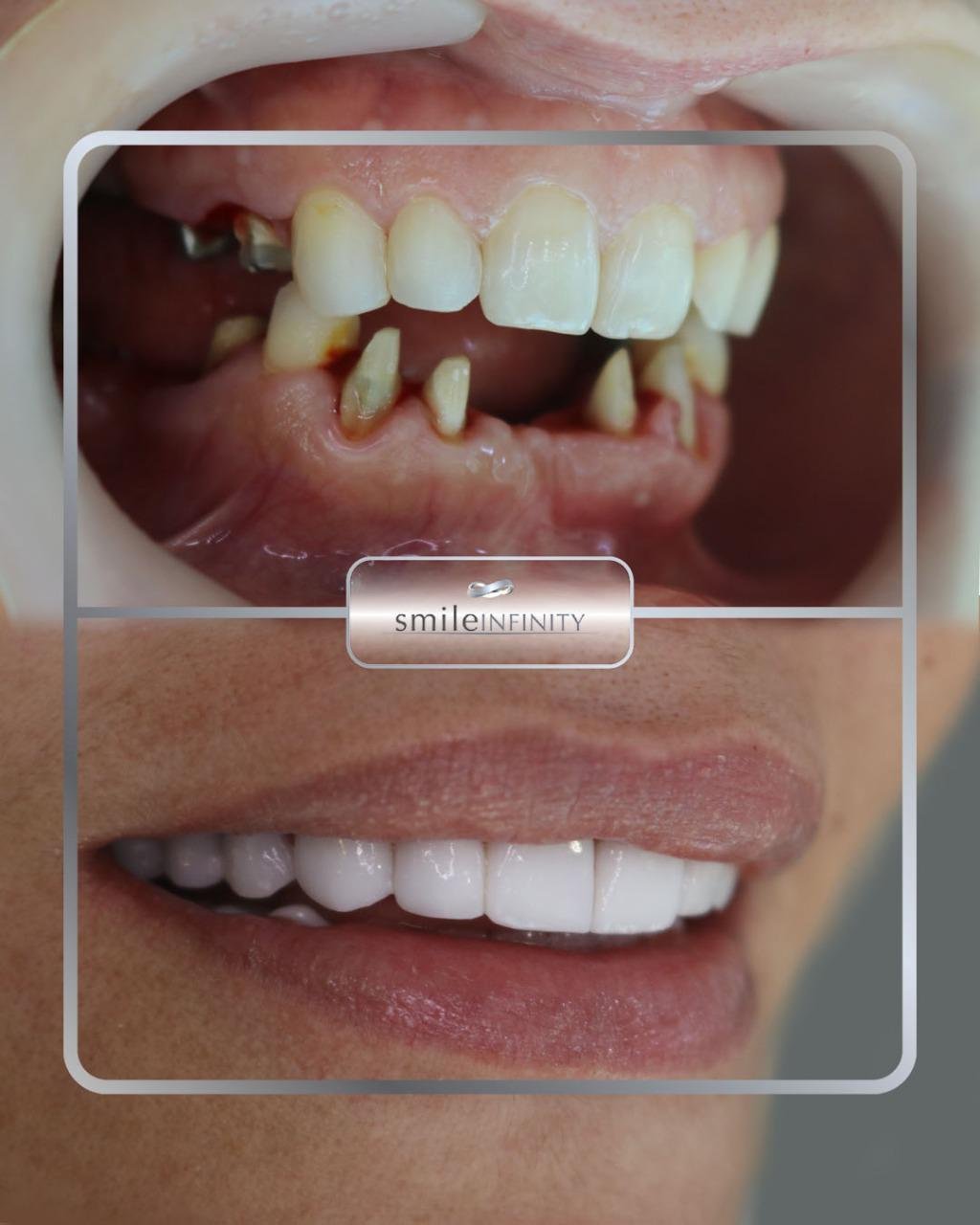 Full mouth rehabilitation before after female patient Smile Infinity Ferrari Dental Clinic Beirut Lebanon Dr Habib Zarifeh