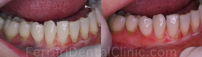 oral-surgery-gum-graft