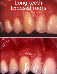 oral-surgery-gum-graft