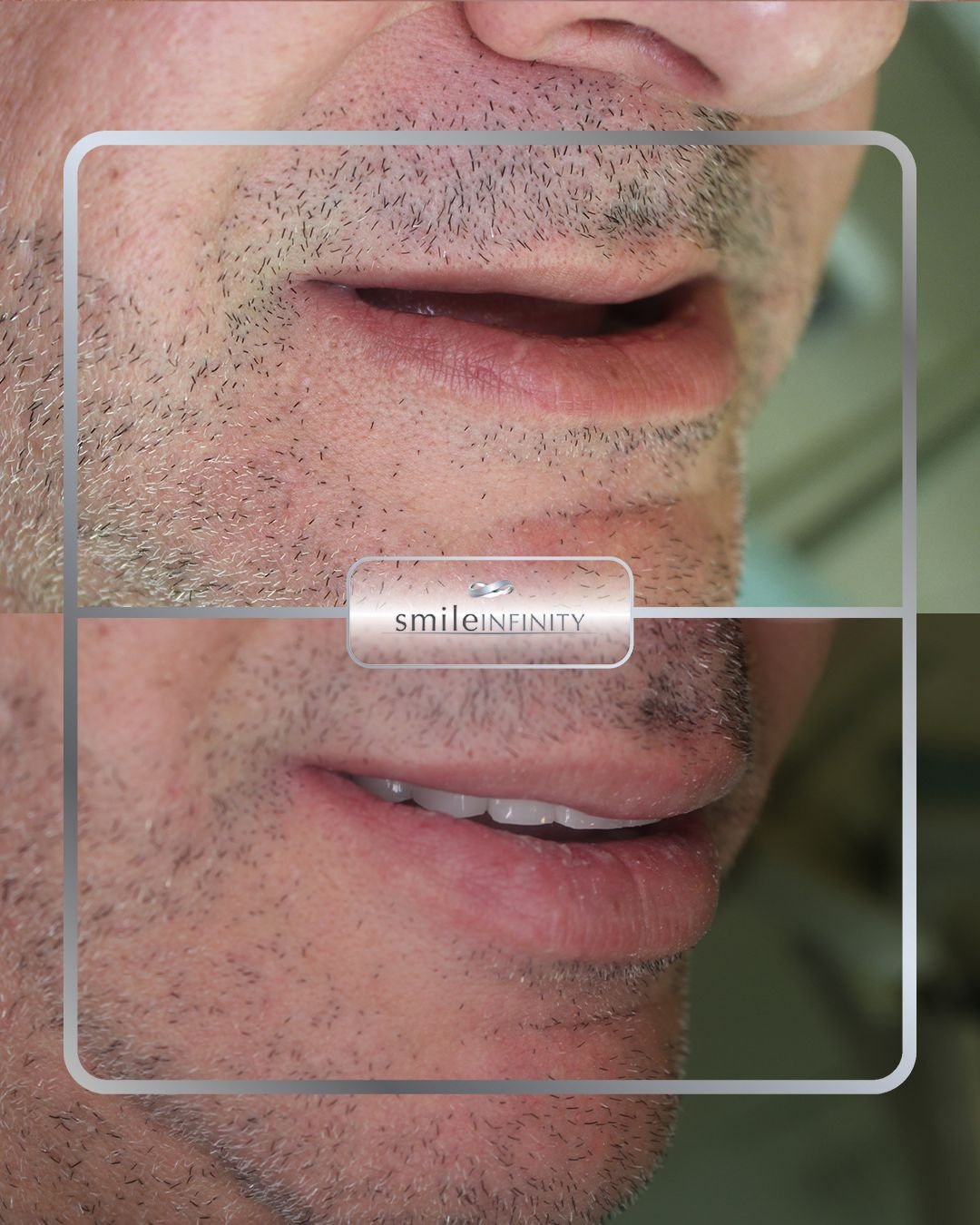 Oral surgery implant restoration before after male Smile Infinity Ferrari Dental Clinic Beirut Lebanon