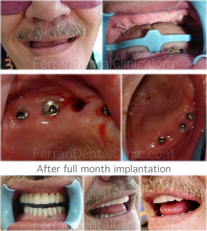 oral-surgery-implants-case2