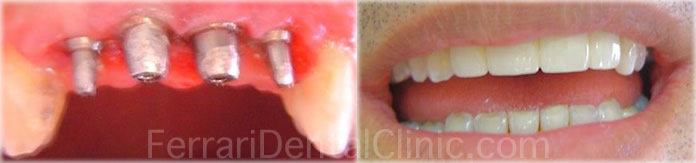 oral-surgery-implants-case3