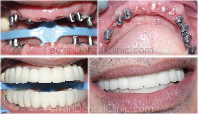 oral-surgery-implants-case5