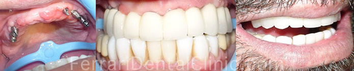 oral-surgery-implants-case6