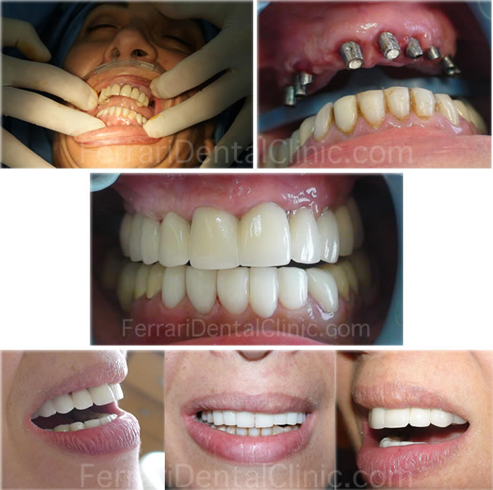 oral-surgery-implants3