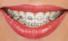 orthodontics-apliances