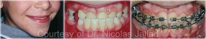 orthodontics Early Treatment of Class 3