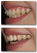 orthodontics-inman4