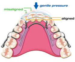 orthodontics-inman5