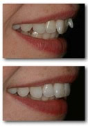 orthodontics-inman6