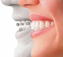 orthodontics-invisalign