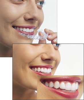 orthodontics-invisalign