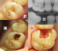 pediatric-laser-dentistry