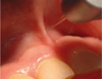 pediatric-laser-dentistry4