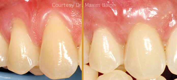 laser-gum-graft