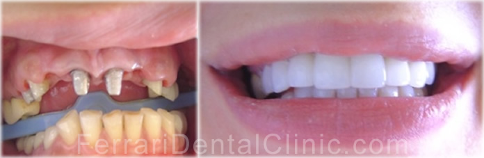 veneers-cosmetics-hollywood-smile