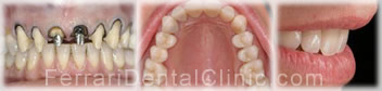 veneers-cosmetics-hollywood-smile5